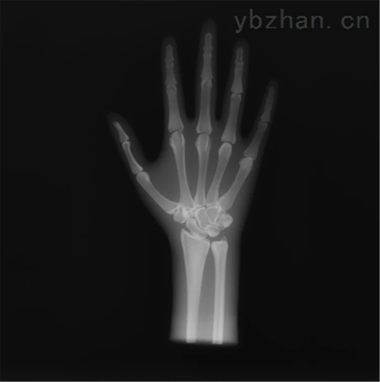 American RSD phantom hand/wrist model phantom image 3